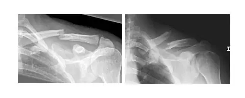 Lesiones de hombro Fractura Clavicula Dr. Manuel Villanueva