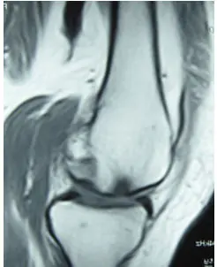Lesiones Cartilago Rodilla Osteonecrosis Especialista en traumatología e infección de prótesis de rodilla Dr. Manuel Villanueva