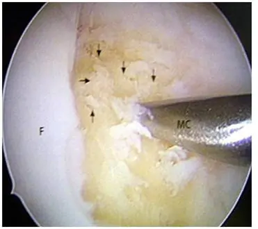 Técnicas de reparación del cartílago Lesiones Cartilago Rodilla Osteonecrosis Dr. Manuel Villanueva