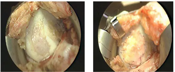 Técnicas de reparación del cartílago. Lesiones Cartilago Rodilla Osteonecrosis Dr. Manuel Villanueva