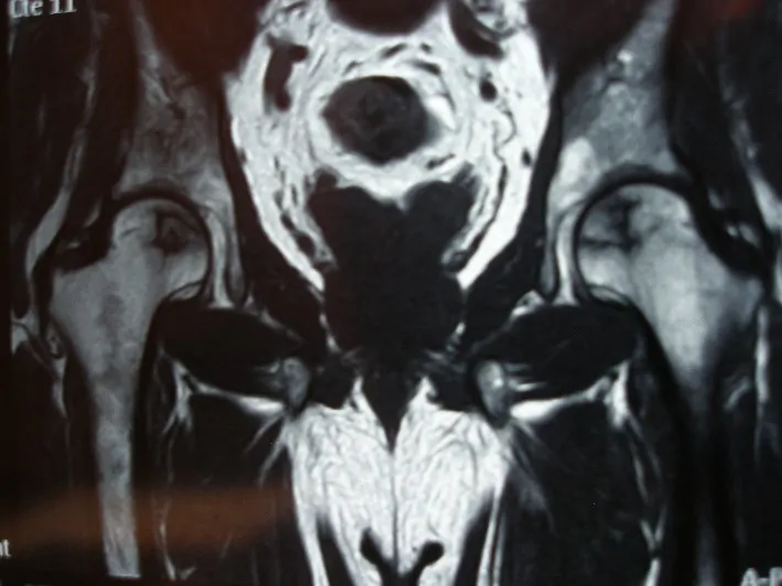 Especialista en cirugía ortopédica y prótesis de cadera: Osteonecrosis Idiopática de Cadera