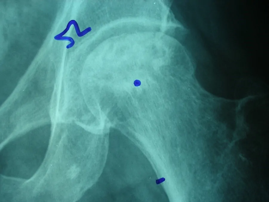 magen de una cabeza femoral necrosada, con la zona colapso subcondral que origina la imagen radiológica de “cáscara de huevo”