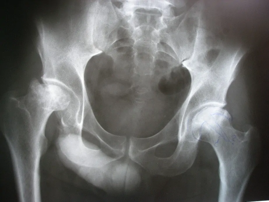 Osteonecrosis bilateral con colapso, deformidad e incongruencia articular. E