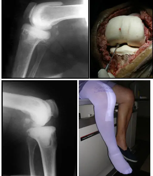 Traumatólogo especialista en cirugía ortopédica de rodilla Infección Prótesis Dr. Manuel Villanueva