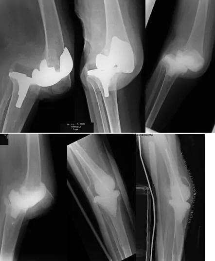 Traumatólogo especialista en cirugía ortopédica de rodilla e infección protésica Dr. Manuel Villanueva