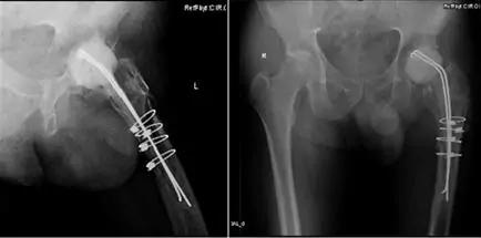 Radiografía de un paciente del Especialista en traumatología e infección de prótesis de rodilla Dr. Manuel Villanueva