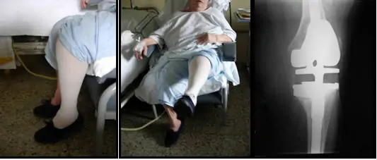 Mujer paciente del Traumatólogo especialista en cirugía ortopédica de rodilla e infección protésica Dr. Manuel Villanueva