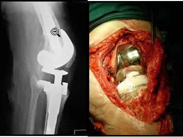 Cirugía del Traumatólogo especialista en cirugía ortopédica de rodilla Dr. Manuel Villanueva