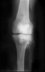 Radiografía de una rodilla con artrosis del Especialista en infección de prótesis de rodilla Dr. Manuel Villanueva