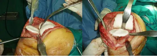 Cirugía abierta de Infección Prótesis Dr. Manuel Villanueva