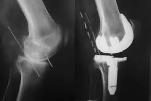 Inestabilidad tras prótesis total de rodilla del especialista en cirugía ortopédica y traumatología Dr Manuel Villanueva