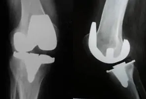 prótesis inestable prótesis total de rodilla por el especialista en cirugía ortopédica y traumatología Dr Manuel Villanueva