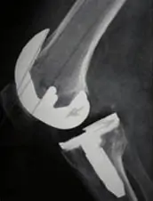 Prótesis de rodilla con inestabilidad