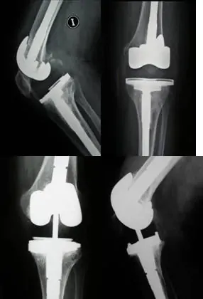 Inestabilidad tras prótesis total cadera y rodilla, prótesis de rodilla dolorosa Dr Manuel Villanueva