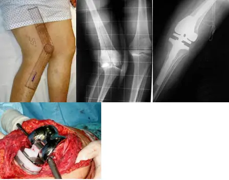 Inestabilidad tras prótesis total cadera y rodilla Dr Manuel Villanueva