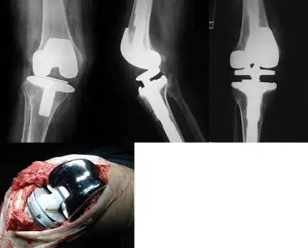 Prótesis de rodilla con inestabilidad