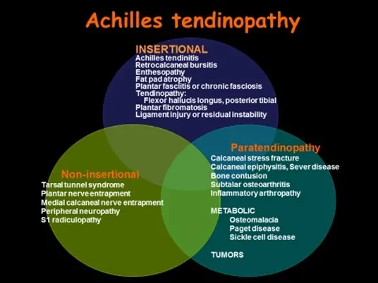 Novedades en la Tendinopatía Aquilea por el especialista en traumatología y lesiones deportivas Dr. Manuel Villanueva