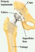 Prótesis Cadera. Educación pacientes con prótesis total de cadera Dr. Manuel Villanueva