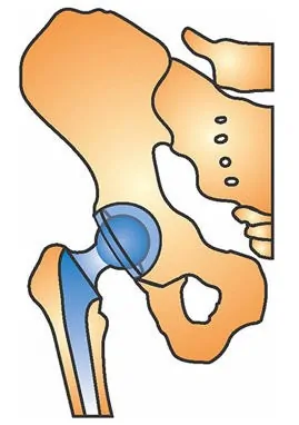 Protesis Cadera. Dr. Manuel Villanueva