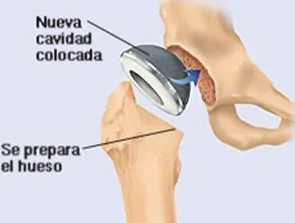 Prótesis Cadera Educación pacientes con prótesis total de cadera Dr. Manuel Villanueva