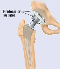 Prótesis Cadera y Rodilla. Educación pacientes con prótesis total de cadera Dr. Manuel Villanueva