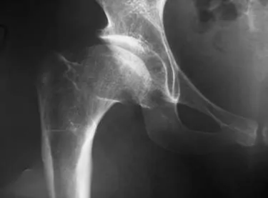Radiografia Tratamiento Farmacológico de la Artrosis