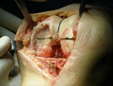 tratamiento-quirurgico-de-la-artrosis-Dr. Manuel Villanueva