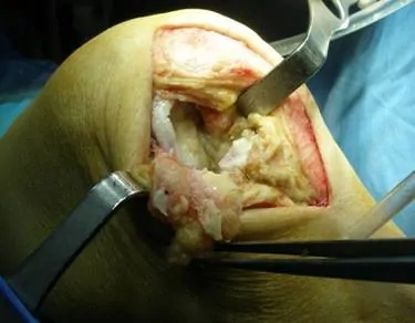 tratamiento-quirurgico-de-la-artrosis-Dr. Manuel Villanueva