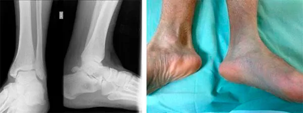 cirugía ecoguiada del síndrome del túnel del tarso. lesiones de tobillo y pie