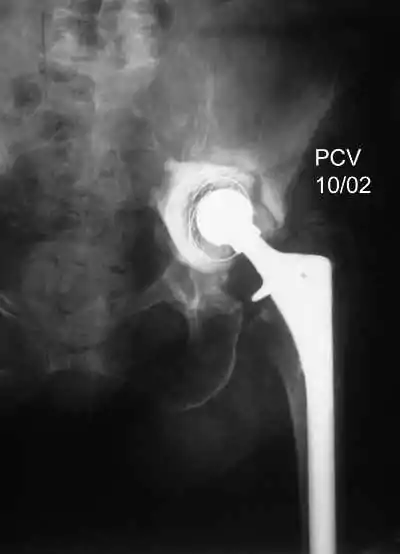Discontinuidad Pélvica por el especialista en prótesis de cadera Dr. Manuel Villanueva. Traumatología y Cirugía Prótesica de casos complejos de cadera
