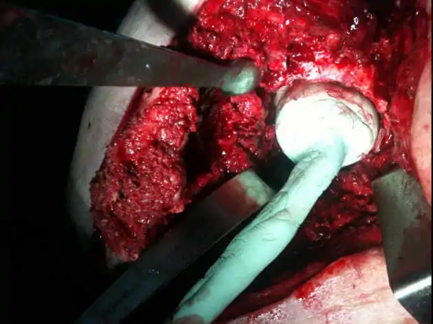 Cirugía y Casos Clínicos Complejos. Infección de Bajo Grado de Prótesis Total de Cadera. Doctor Manuel Villanueva