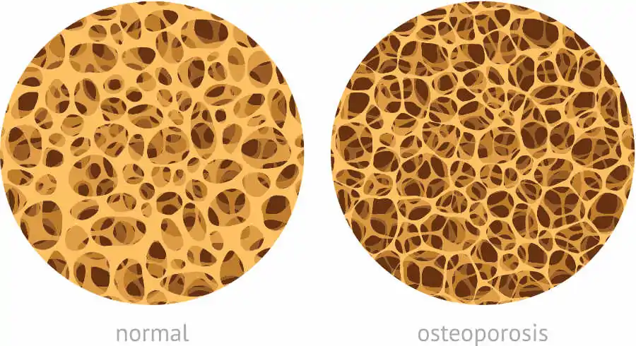 hueso con Osteoporosis versus hueso sin osteoporosis