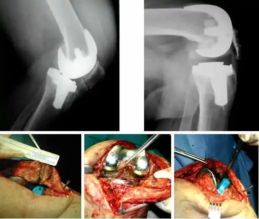prótesis de rodilla dolorosa para especialistas en cirugía ortopédica. La rodilla estaba rígida, con un arco de movilidad 0-40º
