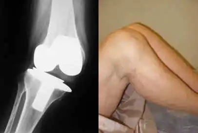 La prótesis de rodilla está en buena posición pero las partes blandas no tienen el equilibrio necesario. Prótesis de rodilla dolorosa para especialistas en cirugía ortopédica