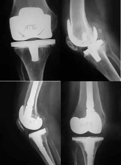 Pruebas de imágen de prótesis de rodilla. prótesis de rodilla dolorosa para especialistas en cirugía ortopédica