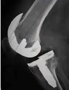 Movimiento errática de una prótesis de rodilla. prótesis de rodilla dolorosa para especialistas en cirugía ortopédica