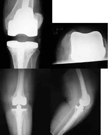 Luxación rotuliana tras una revisión de una prótesis. prótesis de rodilla dolorosa para especialistas en cirugía ortopédica
