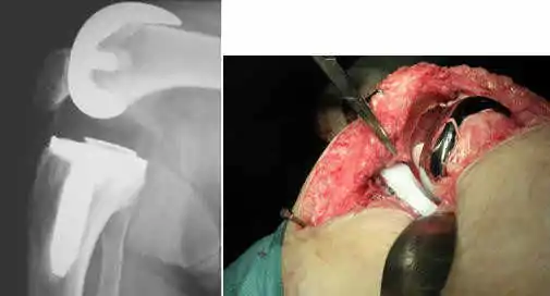 Otro ejemplo de rótula baja en una prótesis con un modelo ultracongruente (polietileno muy conformado) en el que no se había resecado el LCP creándose un “conflicto biomecánico” .prótesis de rodilla dolorosa para especialistas en cirugía ortopédica