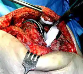 prótesis de rodilla dolorosa para especialistas en cirugía ortopédica