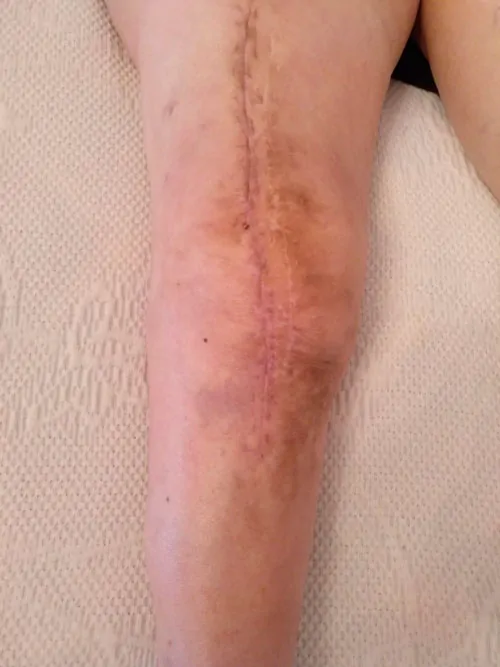 Remedios tenía una infección crónica de una prótesis de rodilla con exposición de la prótesis de 6 meses de evolución.