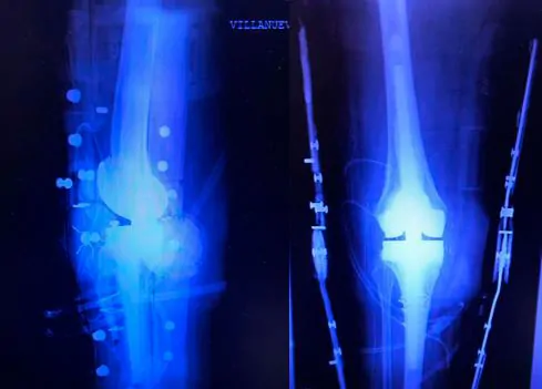 radiografía de la prótesis de rodilla