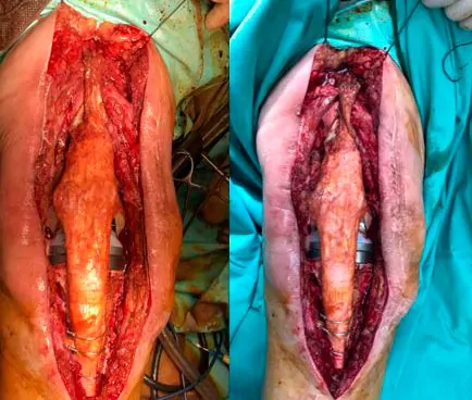 Aloinjerto o trasplante del mecanismo extensor de prótesis de rodilla