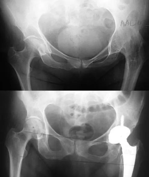 Desartrodesis de cadera conversión de artrodesis en prótesis total de cadera