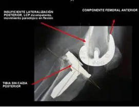 especialista en dolor e inestabilidad de prótesis de rodilla