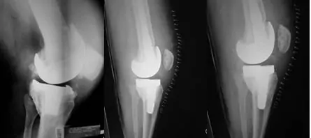 especialista en revision-artroplastia-total-de-rodilla