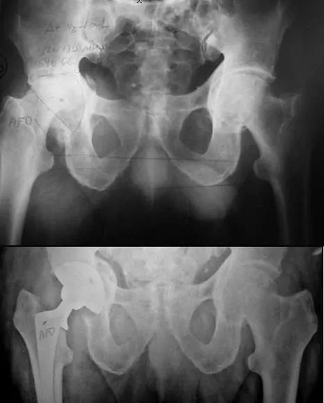 especialista en conversión de artrodesis en prótesis total de cadera