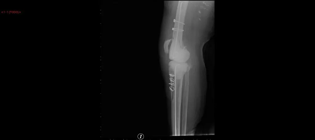 Doctor villanueva especialista en casos complejos de prótesis de rodilla