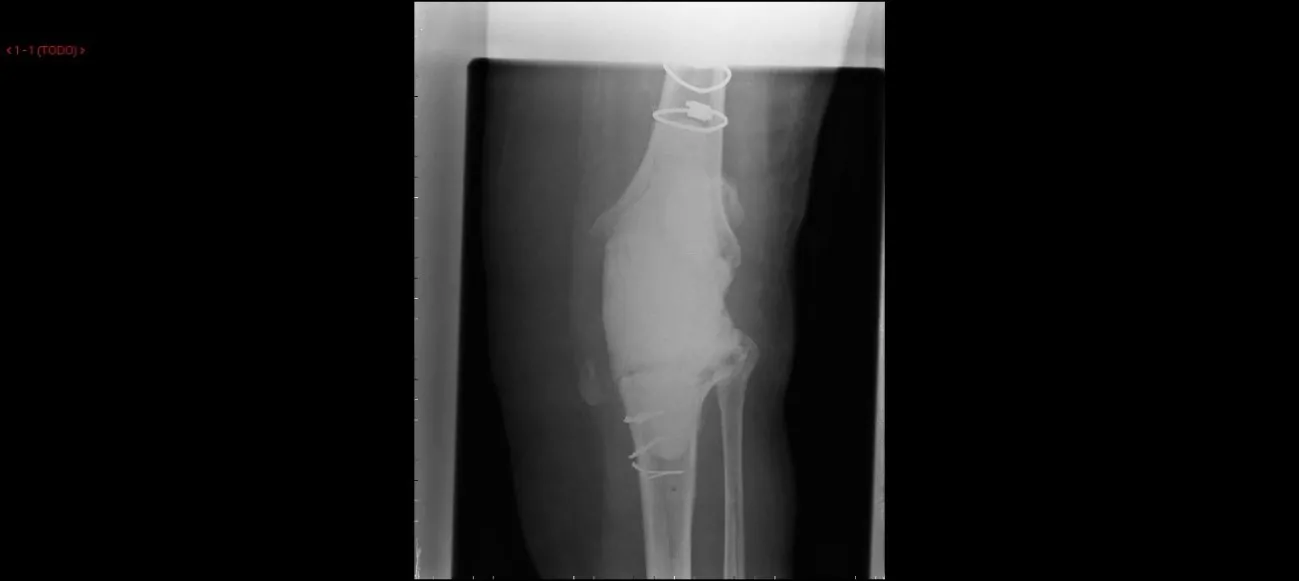 Doctor villanueva especialista en casos complejos de prótesis de rodilla