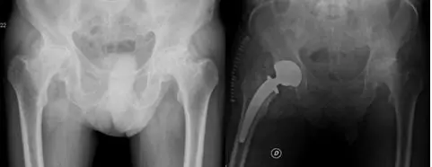 Los resultados publicados con la artroplastia cementada de Charnley, en pacientes de prótesis de cadera y rodilla menores de 50 años, indican tasas de supervivencia a más de 15 años entre el 60-86%.