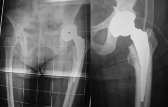 Los vástagos porosos o no cementados de prótesis de cadera pueden ser anatómicos o rectos.
